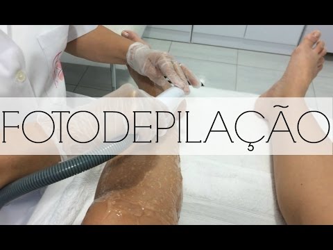 Fotodepilação Técnica Com Luz Pulsada Como é Feita